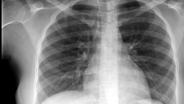 Nucleaire scans brengen dus mogelijke afwijkingen in beeld. Een CT-scan en MRI-scan leveren echter duidelijkere beelden op.