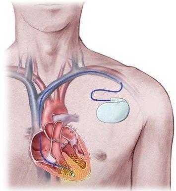 5. Wat zijn de verschillende behandelmethodes van hart- en vaatziekten? Er zijn zeer veel verschillende hart- en vaatziekten.