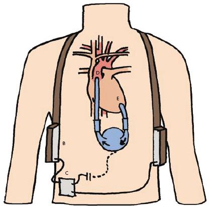 Steunhart Naast de bekende ICD en pacemaker zijn er ook andere interessante behandelmethodes. Een voorbeeld daarvan is het steunhart, een redelijk nieuwe en veelbelovende techniek.