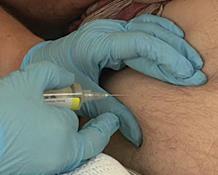 4. Dien de injectie toe Knijp de huid van de buik met één hand samen om een huidplooi te krijgen : zo verloopt het injecteren eenvoudiger.