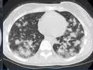 Pulmonair Pneumonitis