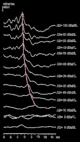 CONFIRMATIE GEHOORVERLIES & BEPALING AARD GEHOORVERLIES Click-BERA (1-4kHz) Geen gehoortest, wel test van de neurale synchronisatie Neuro-otologische