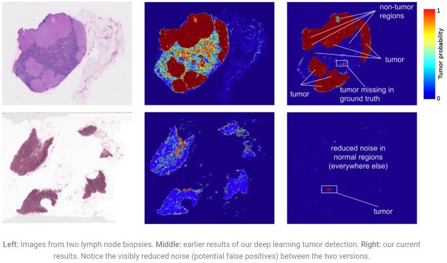 AUTOMATISEREN VAN TUMOREN DETECTIE Deep learning is gebruikt om metastases van borstkanker te herkennen op digitale pathologie beelden Beelden van biopten Standaard algoritme Huidig algoritme Een