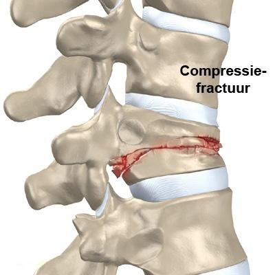 1. Inleiding Graag duiden wij u op het belang van goede informatie in verband met uw opname omwille van een indeukingsfractuur van de wervelkolom.