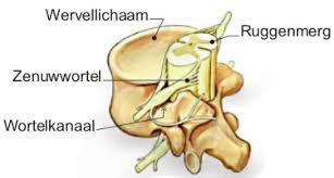 Bij ernstige compressiefracturen (zoals bij een val van hoogte of een verkeersongeval) kunnen fragmenten van het wervellichaam in het wervelkanaal duwen en druk geven tegen het ruggenmerg.