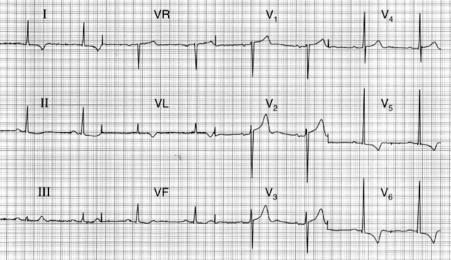 ECG 70