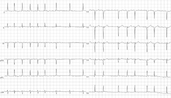 ECG 76