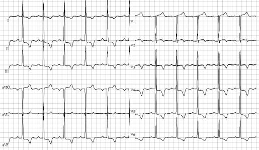 Les 5 ECG