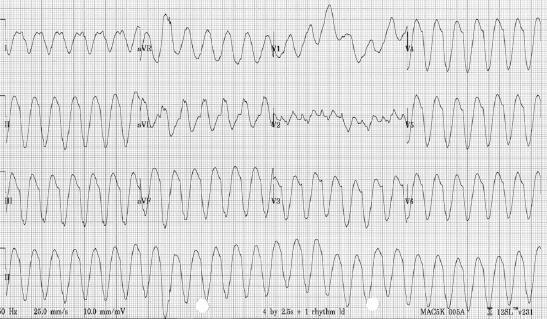 ECG 140 ECG