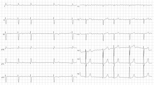 ECG 176