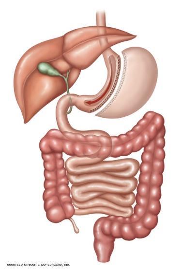 Zwangerschap na bariatrische chirurgie Obesitas is een van de snelst groeiende gezondheidsproblemen in de Westerse wereld (18).