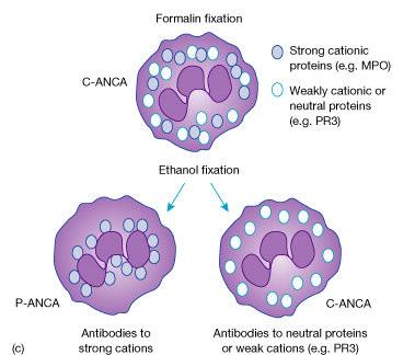 Ethanol versus Formaline fixatie Ethanol fixatie heeft invloed op spreiding van antigenen, sommige migreren richting kern en geven een p-anca beeld Gevolg mogelijke verwarring met