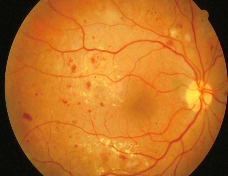 Microaneurysmata Meer bloedinkjes