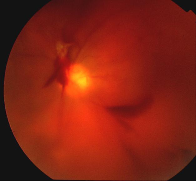 Optic disc (NVD)