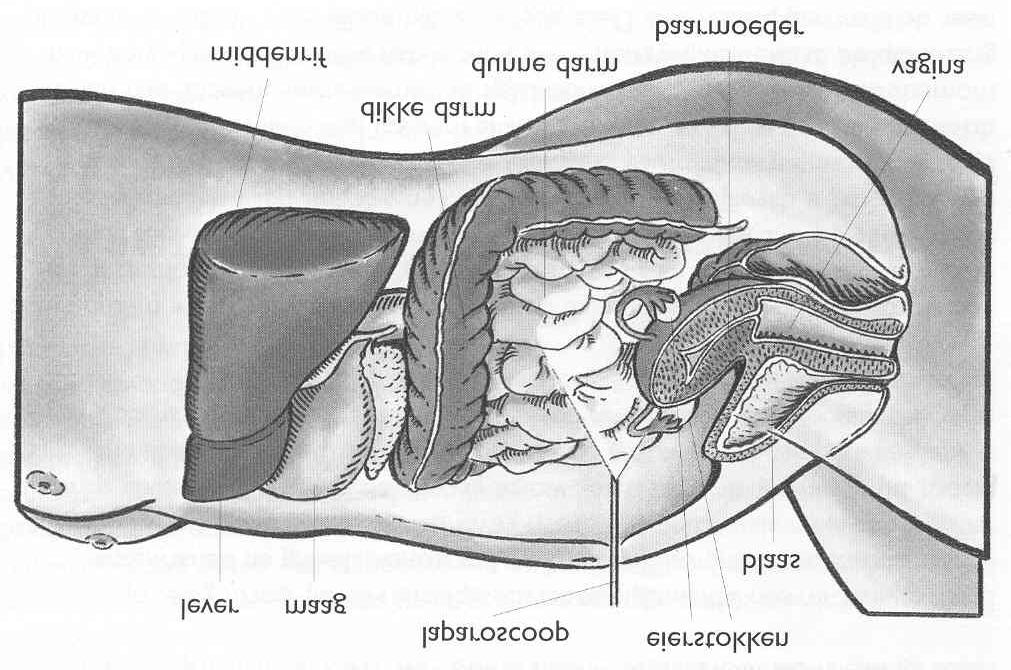 4.1.3 Laparoscopie en hysteroscopie Bij een laparoscopie neemt de arts een kijkje in de buikholte, om te zien of er misschien verklevingen rond de eileiders en eierstokken zijn.