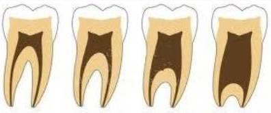3. Dentale bevindingen Taurodontisme