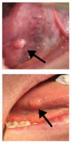 1. Bevindingen in zachte weefsels Orale neurofibromen: 4 case-series, 1