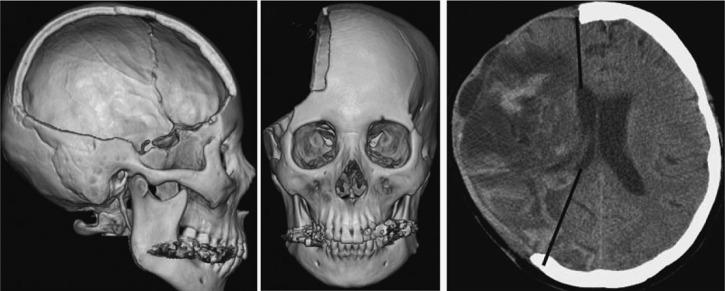 Ernstig schedel-hersenletsel Verhoogde intracraniële druk Mannitol/hypertoon zout Hyperventilatie