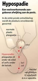 HYPOSPADIE Tijdens de embryologische ontwikkeling is de aanleg van het plaskanaal eerst een vlakke plaat (urethrale plaat).