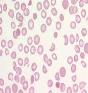 Trombotische trombocytopenische purpura () Volwassenen: Congenitale : ZZ, door