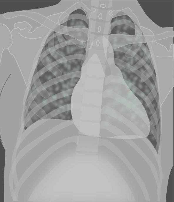 zuurstofsaturatie van 90%. Het laboratoriumonderzoek toont een leukopenie van 1,0 10 9 /l en een metabool gecompenseerde respiratoire alkalose met hypoxemie.