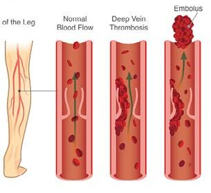 Wat is trombose? Ontstaan, symptomen & risicofactoren Bij een trombose raakt een bloedvat in het lichaam verstopt door een bloedstolsel.