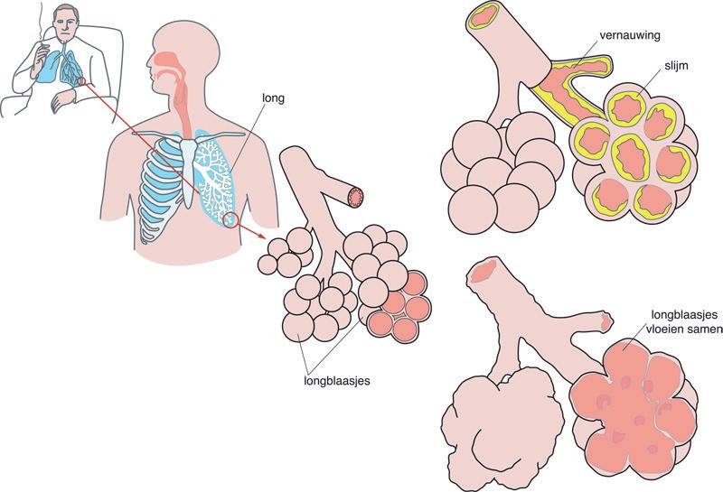 Informatie over COPD COPD staat voor Chronic Obstructive Pulmonary Disease. COPD is een verzamelnaam voor de longziekten longemfyseem en chronische bronchitis.