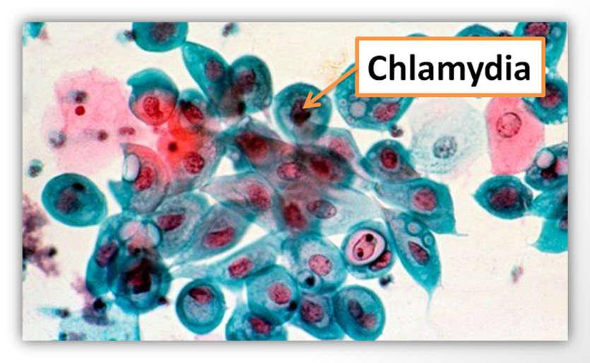 6.8 Seksueel overdraagbare Chlamydia De meest voorkomende soa in Nederland Door een bacterie Ziekteverschijnselen: - vaak niets van te merken - soms (waterige)