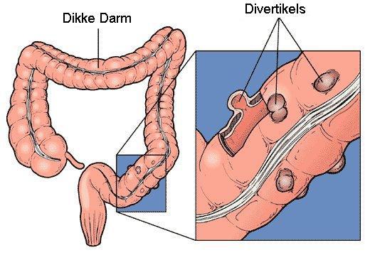Divertikels kunnen zowel in de slokdarm, de dunne darm als in de dikke darm voorkomen. Verreweg de meeste divertikels ontstaan in de dikke darm.