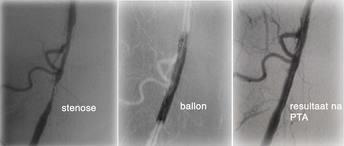 Percutane Transluminale Angioplastie Ballon