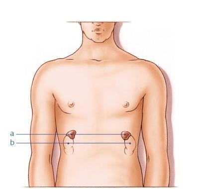 Bijniertumoren en erfelijkheid Bijnierschorsadenoom o Verhoogd risico bij Multipele Endocriene Neoplasie type 1 of 2 (MEN1/2) Bijnierschorscarcinoom o Verhoogd risico bij MEN1 Feochromocytoom o