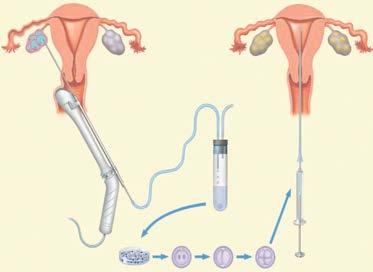 stimulatie Eicelmaturatie Eicelaspiratie In vitro