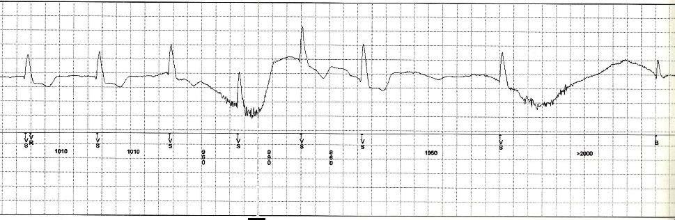 30 sl/min 27 sl/min > 5 s