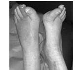 risico op voetletsels bij een patiënt met diabetes is belangrijk