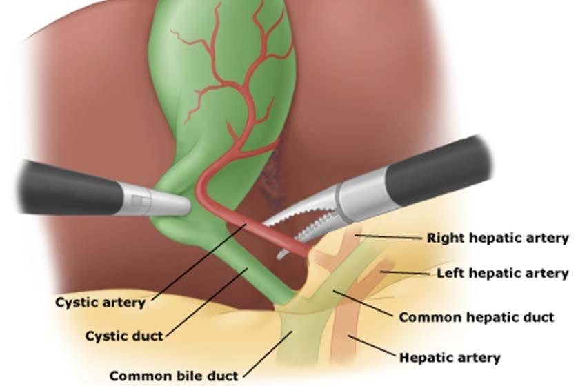 Hoewel de meeste gevallen van galsteenziekte behandeld worden door middel van een laparoscopie, kunnen bepaalde ingewikkelde gevallen vooral de zwaar acute of chronische ontstekingen van de galblaas