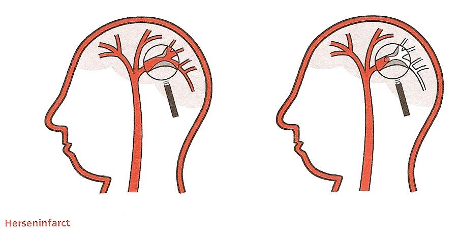 1/6 Neurologie TIA (Transiënt Ischaemic Attack) Inleiding U bent opgenomen op de afdeling neurologie van het Streekziekenhuis Koningin Beatrix.