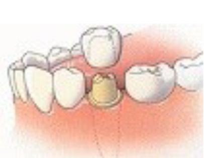 Kronen en bruggen. Duurzame vervangingen voor tanden en kiezen Kronen en bruggen zijn bedoeld als duurzame vervangingen voor tanden en kiezen.