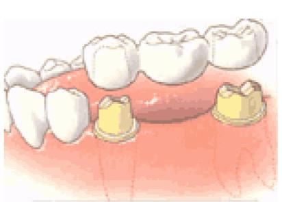 Wanneer kan een brug nodig zijn? 1. Om beter te kunnen kauwen. 2. Verbetering van het uiterlijk. 3. Om te voorkomen dat tanden en kiezen scheef gaan staan en/of gaan uitgroeien.