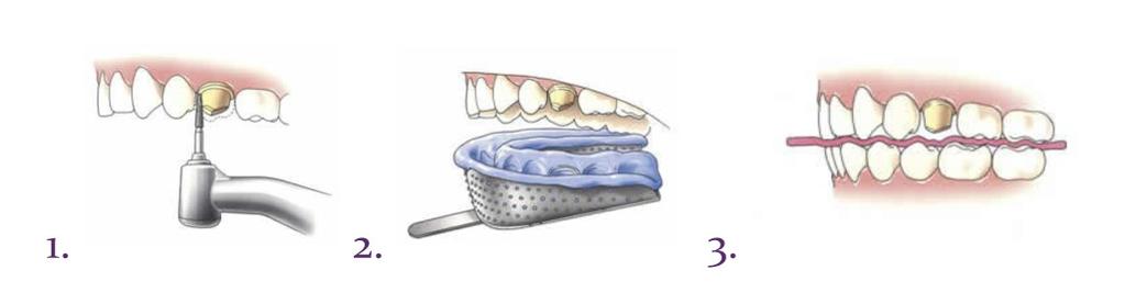 De behandeling in stappen Afslijpen van de tand of kies Allereerst wordt een deel van de tand of kies afgeslepen, totdat er genoeg ruimte is om een kroon of brug te maken.