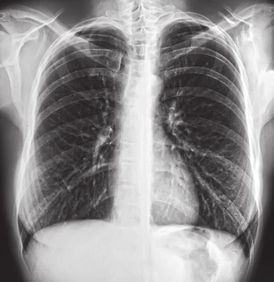 BASISSTOF thema 1 Verbranding en ademhaling 3 Leg uit dat bij kinderen met habitueel mondademen vaker bronchitis voorkomt dan bij kinderen die door hun neus ademen.