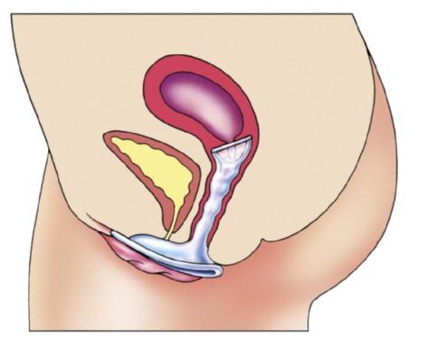 Spiraaltjes Een spiraaltje wordt in de baarmoeder gedaan. Je hebt twee soorten; een hormoonspiraaltje, geeft elke dag wat hormonen af.