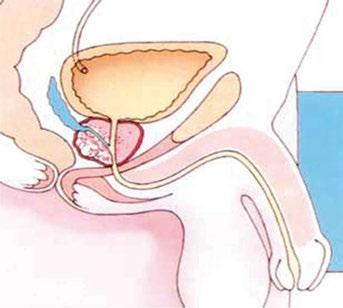 Introductie Direct behandelen of actief volgen? De prostaat De prostaat is een klier die zich rondom de plasbuis en onder de urineblaas bevindt (zie plaatje).