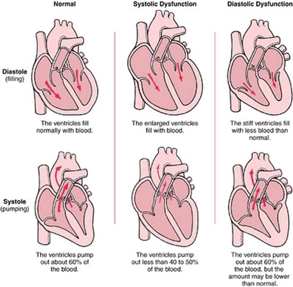 Normaal Systolisch HF Diastolisch HF Indeling Diastole (vullen) HF Normale ventrikels Vergrote ventrikels Stijve
