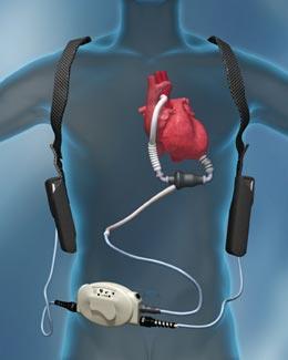 pacemakers Ventriculaire assistentie