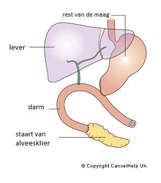 De dunne darm wordt gebruikt om een nieuwe verbinding te maken tussen maag, alvleesklier, galwegen en darmen.