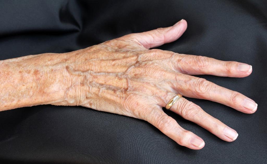 ARTROSE VINGERS Hands On Care Diagnose en onderzoek Artrose is een aandoening die veel voorkomt aan de handen.