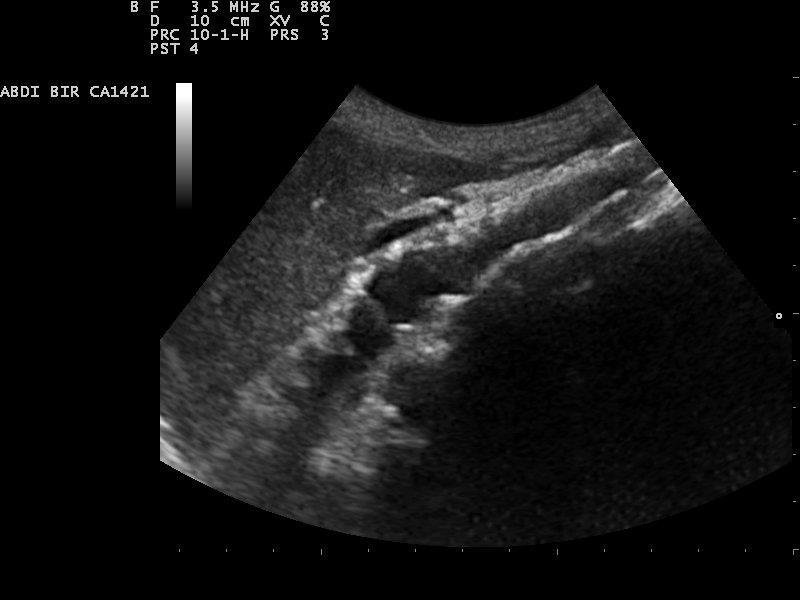 aanvullende test is dan een teendrukmeting Teendruk: kritieke grenswaarde <