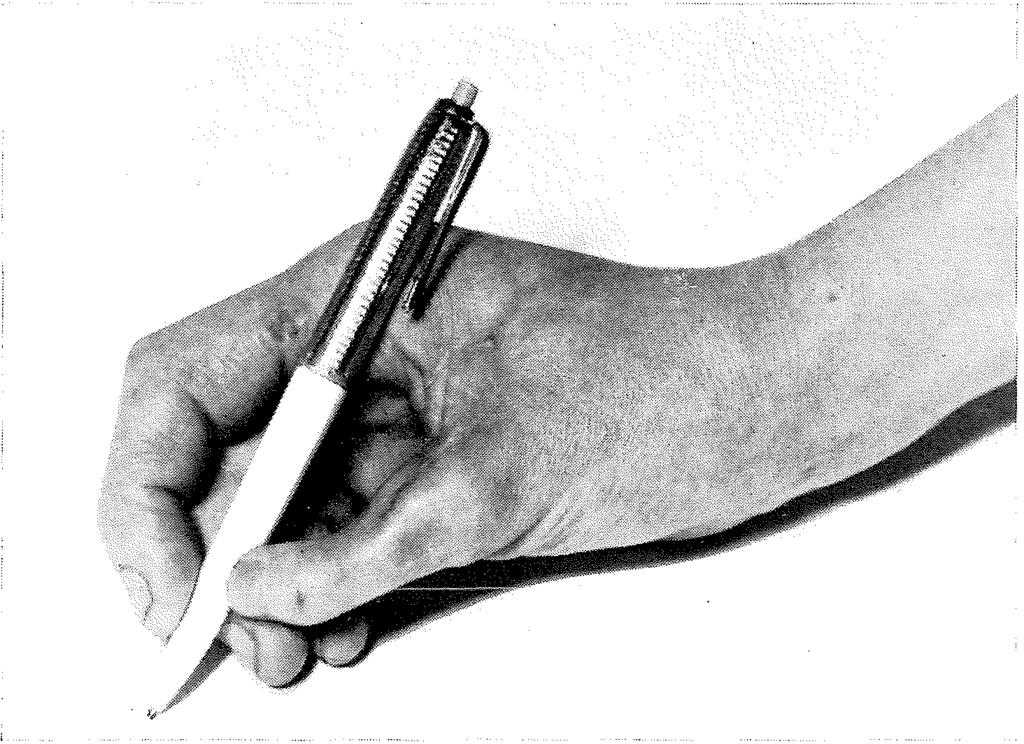 geheven en de beide voormalige gewrichten van de duim zijn goed geconsolideerd. De duim kan nu bij het grijpen en bij de meeste fijnere functies goed gebruikt worden (Fig. 14). Fig.