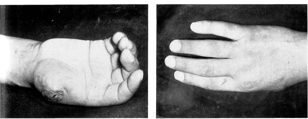 Fig. 3;a Fig. 3;b Casus 13. Patient Vr. (1959), man, 33 jaar. Een maand geleden verwondde patient zijn rechter duim op ernstige wijze, zodat deze necrotiseerde.