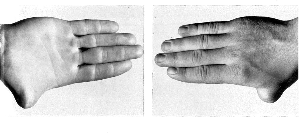 Fig. 37a Fig. 37b Casus 14. Patient S. (1961), man, 19 jaar.